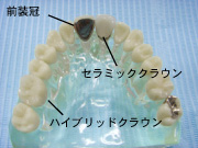 前装冠　セラミッククラウン　ハイブリッドクラウン